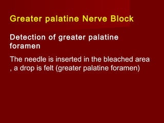 Greater palatine Nerve Block
Detection of greater palatine
foramen
The needle is inserted in the bleached area
, a drop is felt (greater palatine foramen)

 