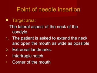 Point of needle insertion
Target area:
The lateral aspect of the neck of the
condyle
1. The patient is asked to extend the neck
and open the mouth as wide as possible
2. Extraoral landmarks:
•
Intertragic notch
•
Corner of the mouth


 