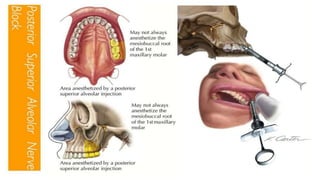 Local Anaesthesia Injection Techniques of local anaesthesia | PPTX
