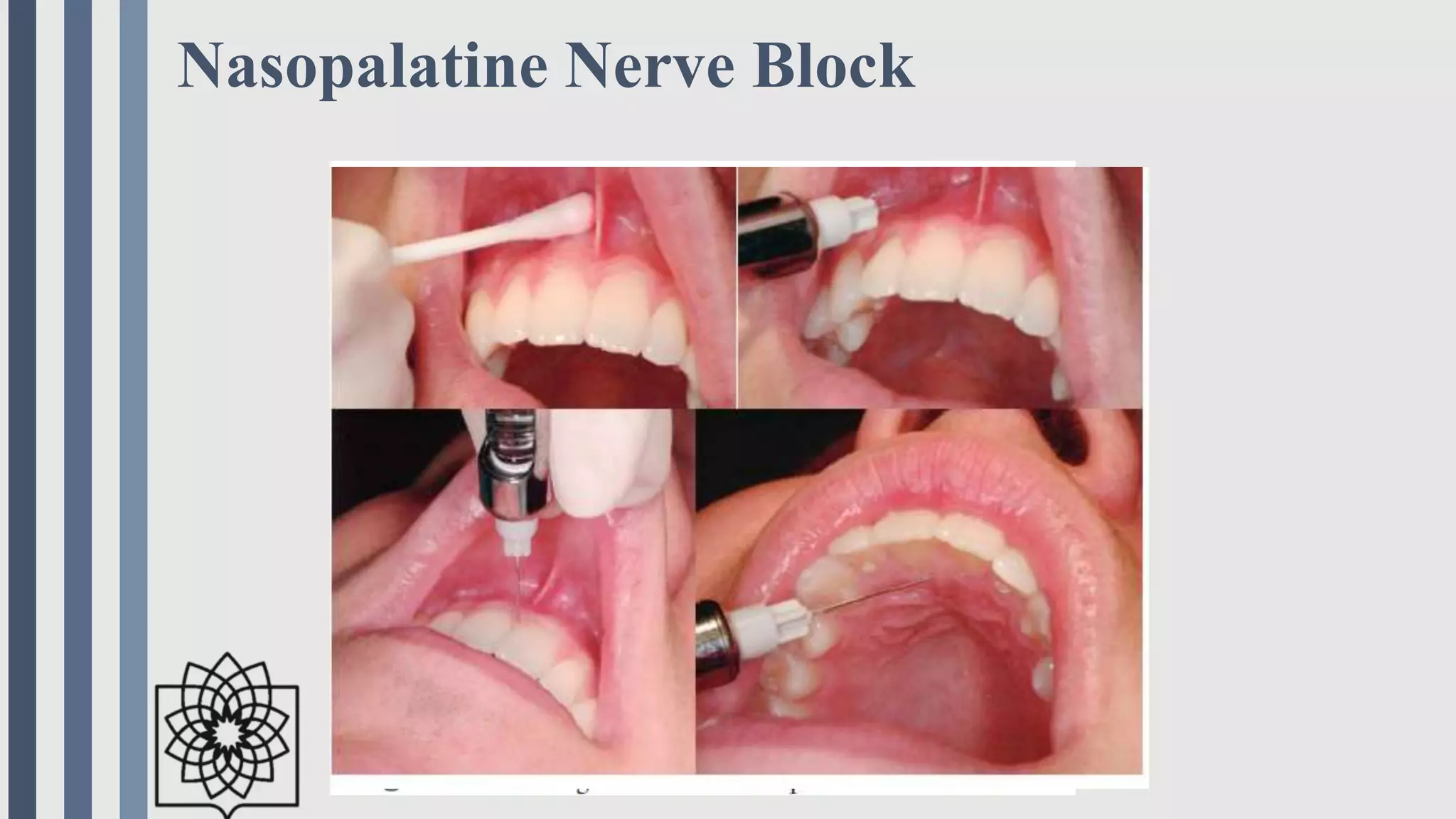 Np Injection Techniques of local anesthesia in dentistry IN A NUTSHELL | PPTX