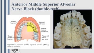 Techniques of local anesthesia in dentistry IN A NUTSHELL | PPTX