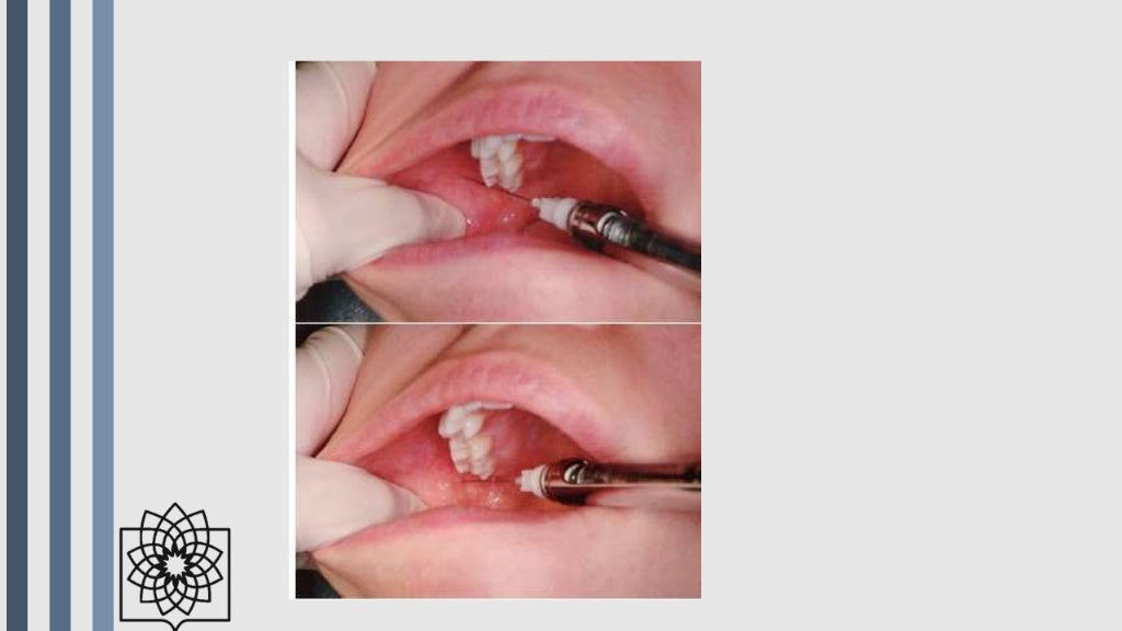 Techniques of local anesthesia in dentistry IN A NUTSHELL