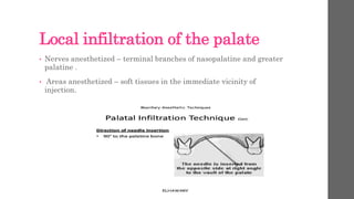 Local infiltration of the palate
• Nerves anesthetized – terminal branches of nasopalatine and greater
palatine .
• Areas anesthetized – soft tissues in the immediate vicinity of
injection.
 