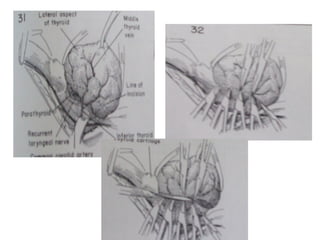 Substernal Approach Techniques of Thyroidectomy.pptTechniques of Thyroidectomy.ppt