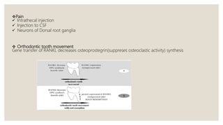 Pain
 Intrathecal injection
 Injection to CSF
 Neurons of Dorsal root ganglia
 Orthodontic tooth movement
Gene transfer of RANKL decreases osteoprostegrin(suppreses osteoclastic activity) synthesis
 