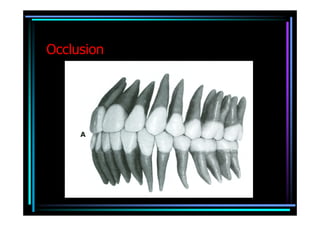 Occlusion
 