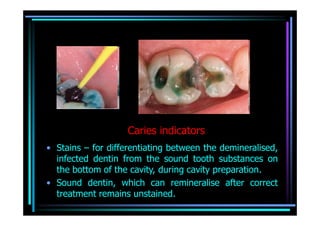 Caries indicators
• Stains – for differentiating between the demineralised,
  infected dentin from the sound tooth substances on
  the bottom of the cavity, during cavity preparation.
• Sound dentin, which can remineralise after correct
  treatment remains unstained.
 