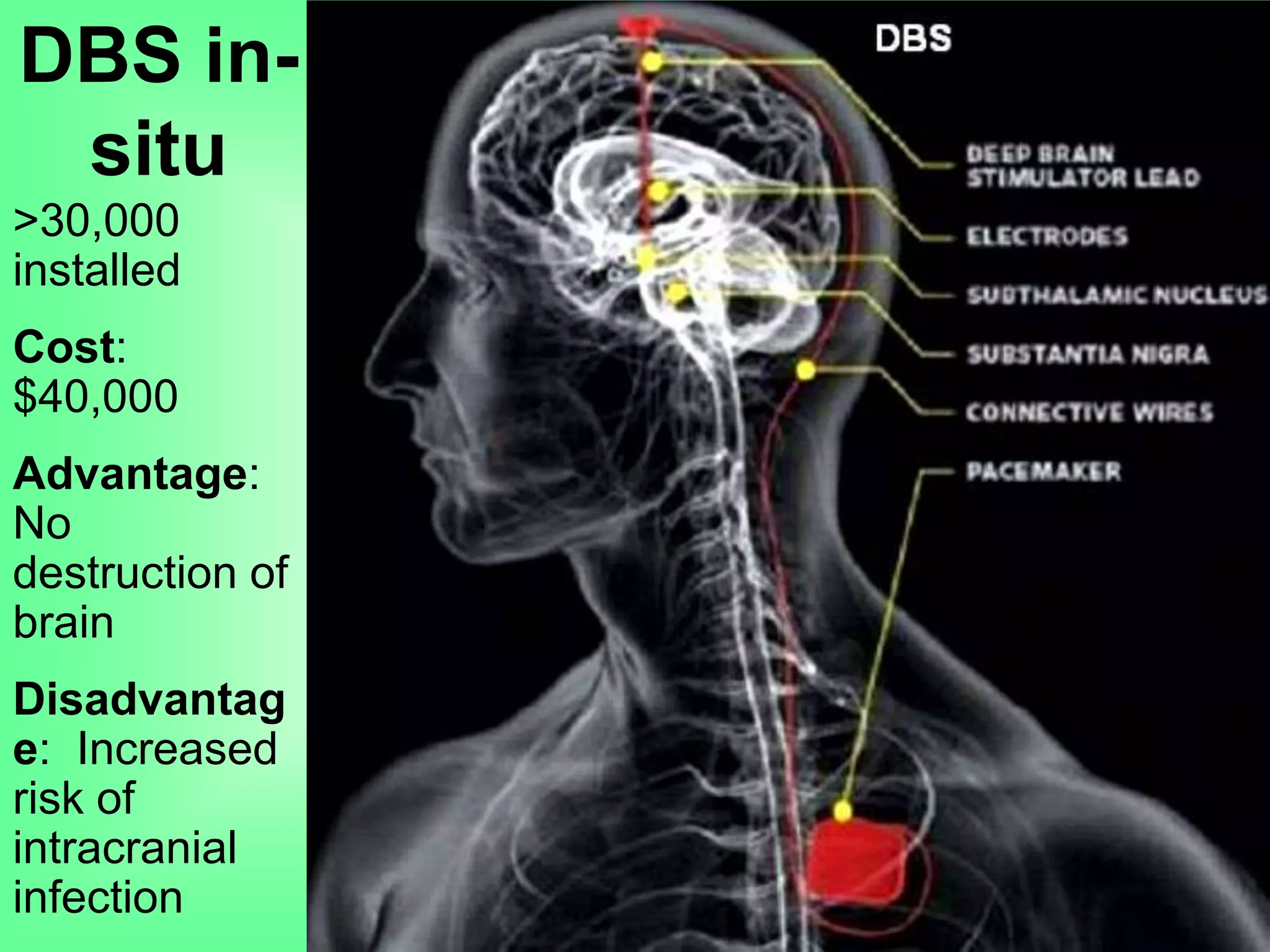 DBS in-
situ
>30,000
installed
Cost:
$40,000
Advantage:
No
destruction of
brain
Disadvantag
e: Increased
risk of
intracranial
infection
 