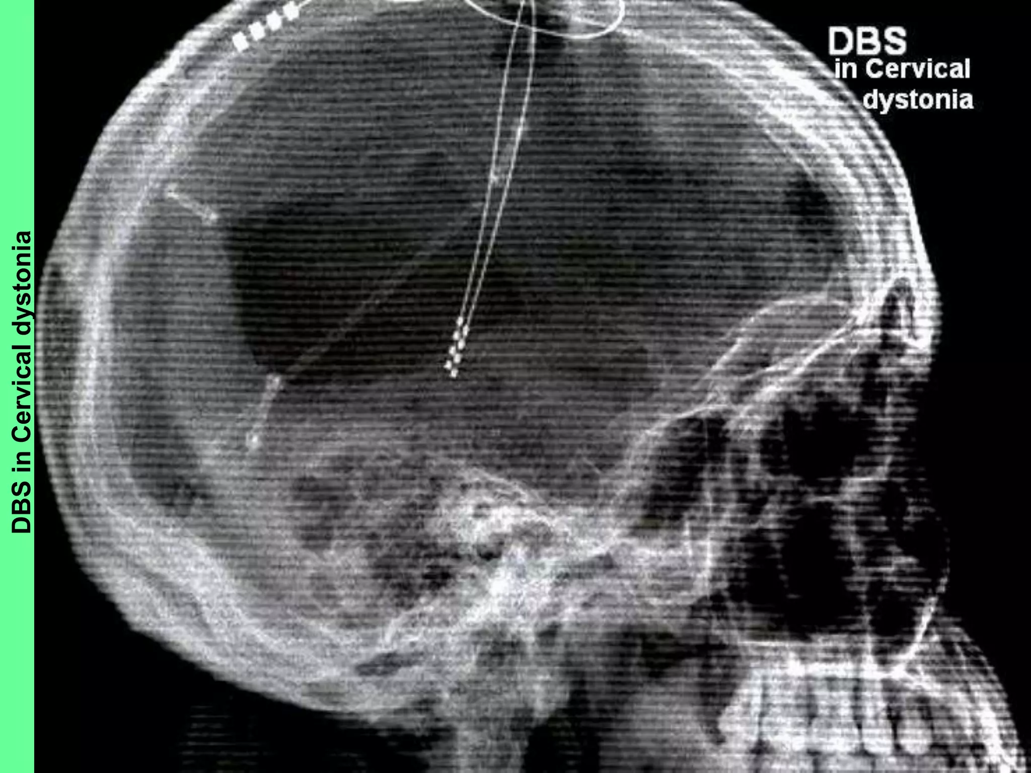 DBSinCervicaldystonia
 