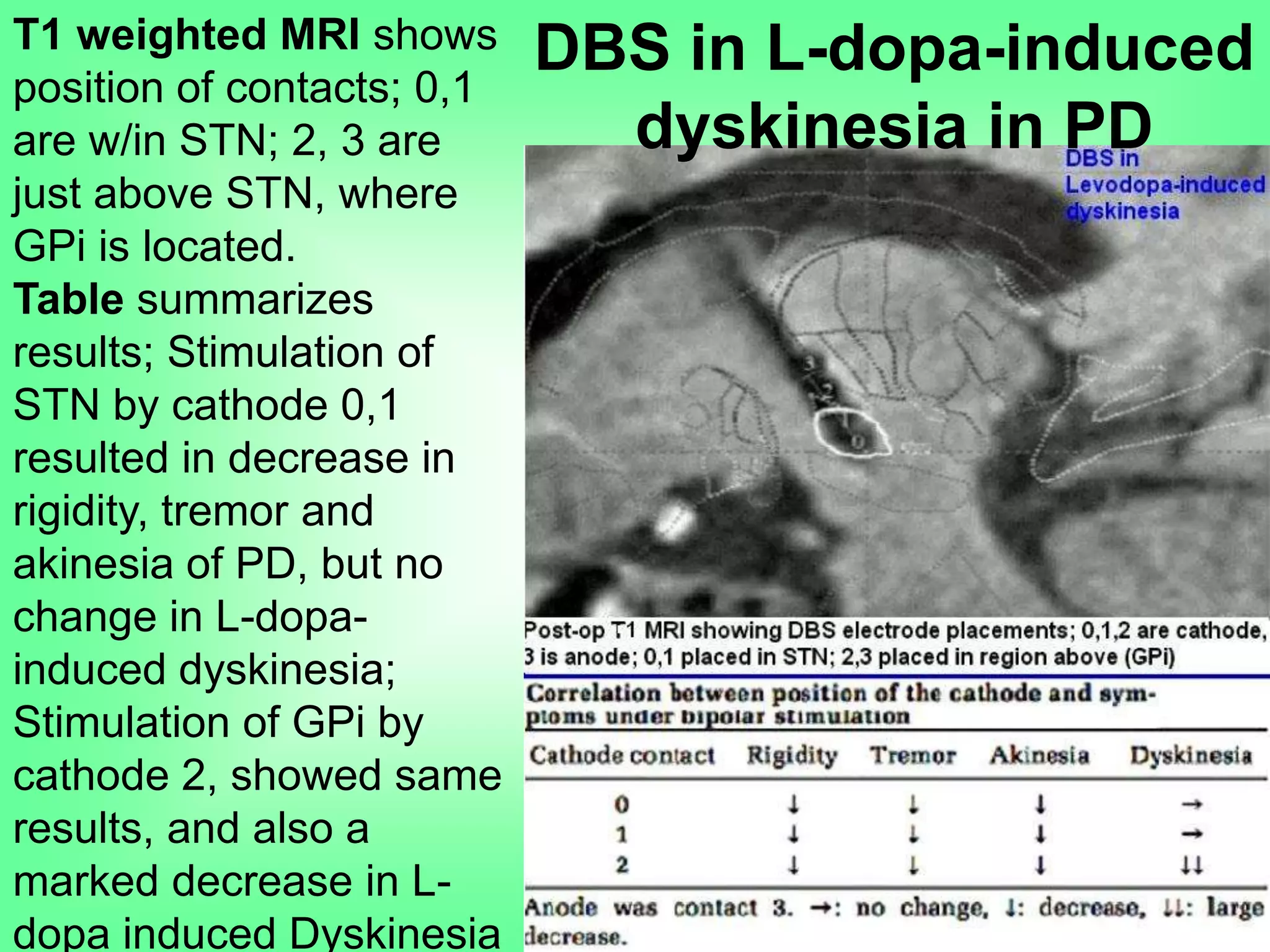 T1 weighted MRI shows
position of contacts; 0,1
are w/in STN; 2, 3 are
just above STN, where
GPi is located.
Table summarizes
results; Stimulation of
STN by cathode 0,1
resulted in decrease in
rigidity, tremor and
akinesia of PD, but no
change in L-dopa-
induced dyskinesia;
Stimulation of GPi by
cathode 2, showed same
results, and also a
marked decrease in L-
dopa induced Dyskinesia
DBS in L-dopa-induced
dyskinesia in PD
 