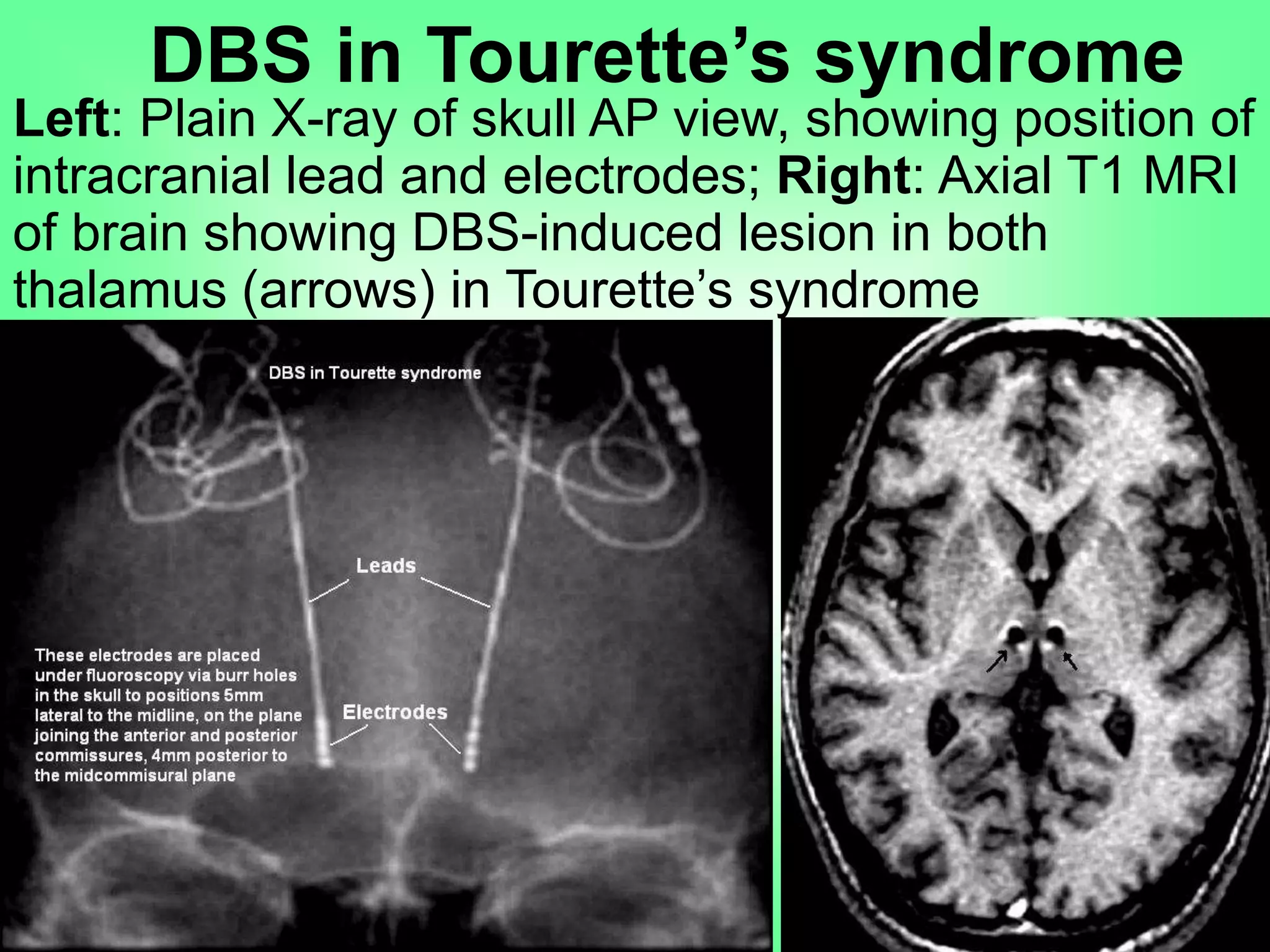 DBS in Tourette’s syndrome
Left: Plain X-ray of skull AP view, showing position of
intracranial lead and electrodes; Right: Axial T1 MRI
of brain showing DBS-induced lesion in both
thalamus (arrows) in Tourette’s syndrome
 