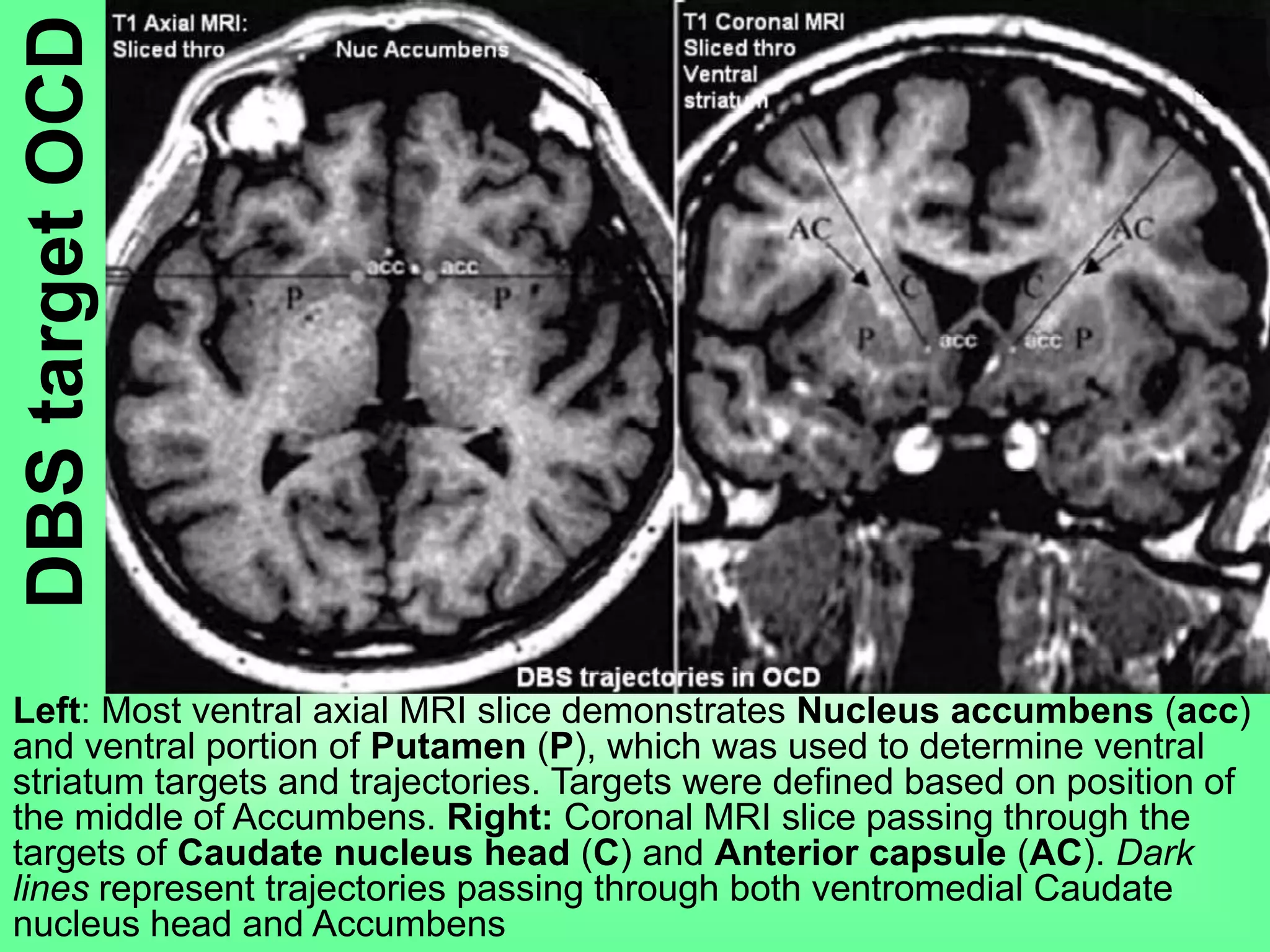 DBStargetOCD
Left: Most ventral axial MRI slice demonstrates Nucleus accumbens (acc)
and ventral portion of Putamen (P), which was used to determine ventral
striatum targets and trajectories. Targets were defined based on position of
the middle of Accumbens. Right: Coronal MRI slice passing through the
targets of Caudate nucleus head (C) and Anterior capsule (AC). Dark
lines represent trajectories passing through both ventromedial Caudate
nucleus head and Accumbens
 