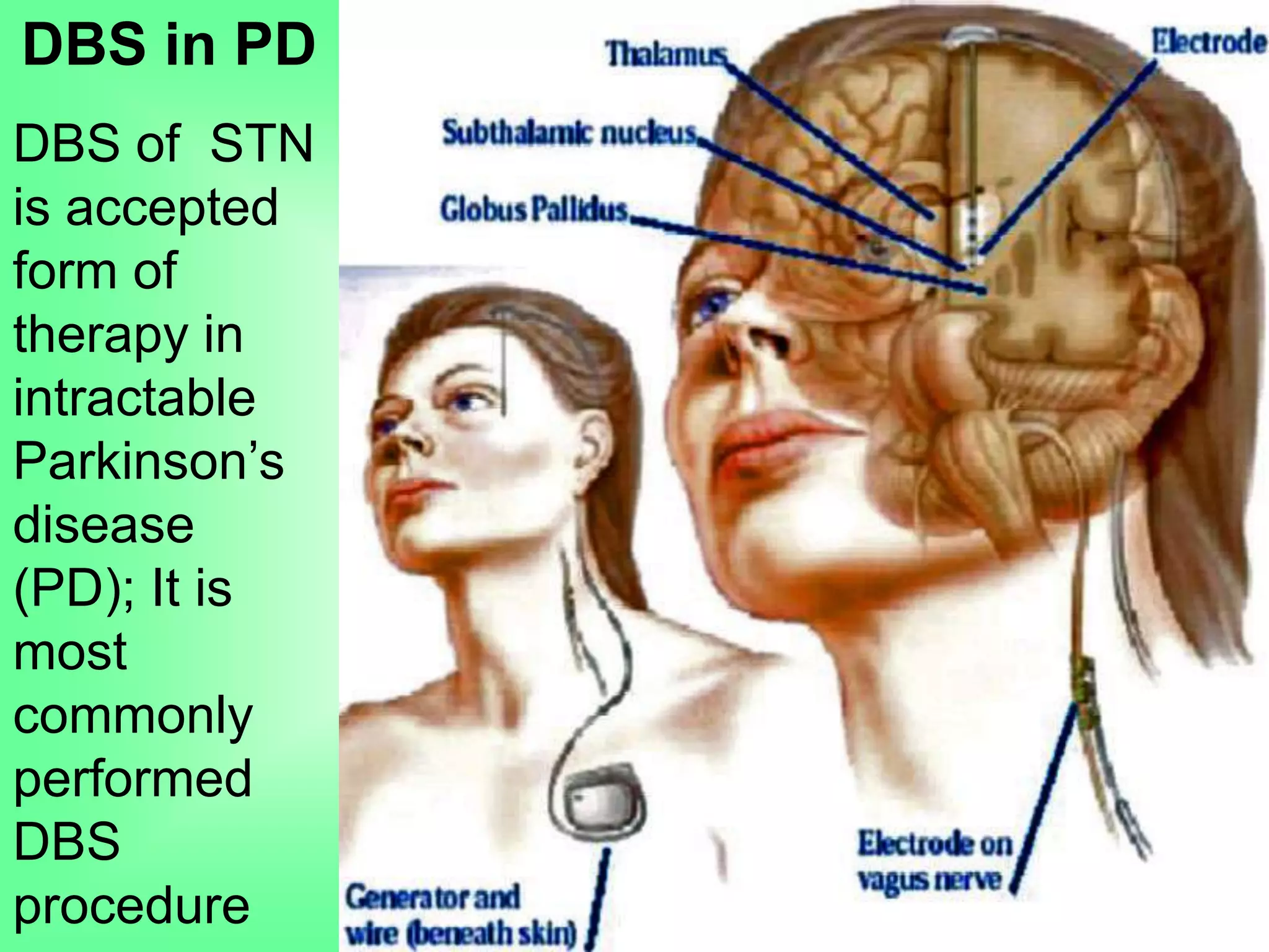 DBS in PD
DBS of STN
is accepted
form of
therapy in
intractable
Parkinson’s
disease
(PD); It is
most
commonly
performed
DBS
procedure
 