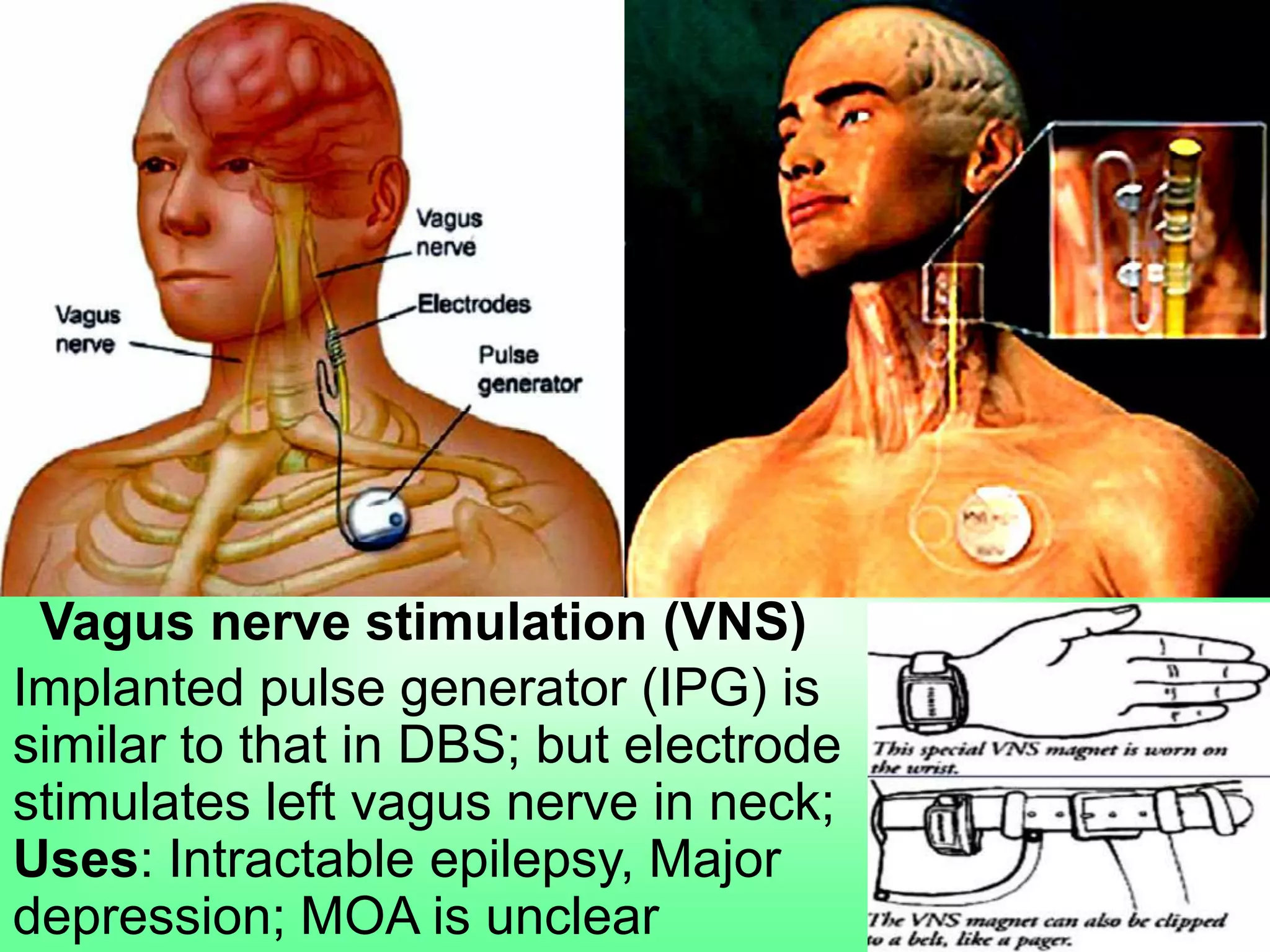 Vagus nerve stimulation (VNS)
Implanted pulse generator (IPG) is
similar to that in DBS; but electrode
stimulates left vagus nerve in neck;
Uses: Intractable epilepsy, Major
depression; MOA is unclear
 