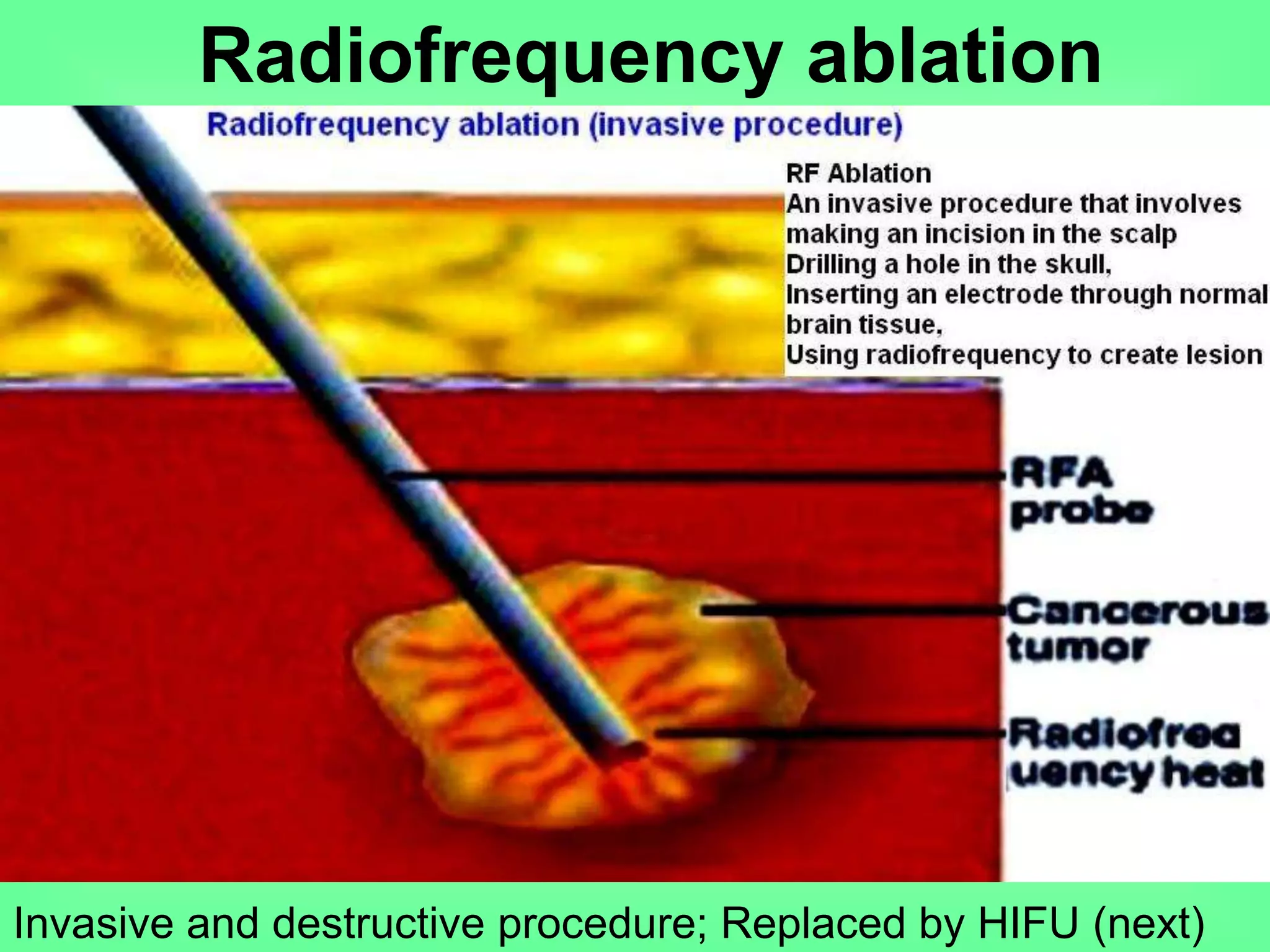 Radiofrequency ablation
Invasive and destructive procedure; Replaced by HIFU (next)
 