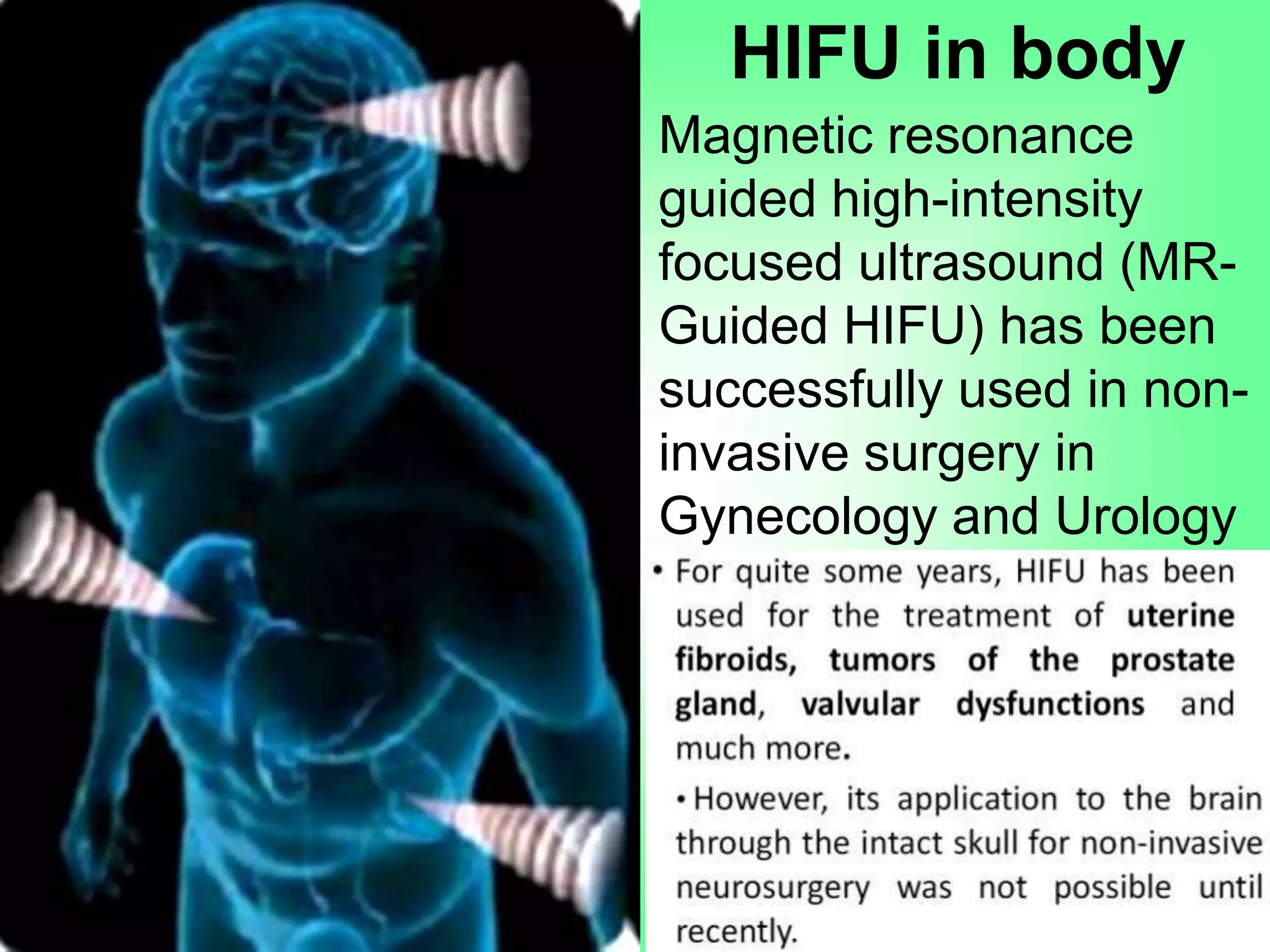 Magnetic resonance
guided high-intensity
focused ultrasound (MR-
Guided HIFU) has been
successfully used in non-
invasive surgery in
Gynecology and Urology
HIFU in body
 
