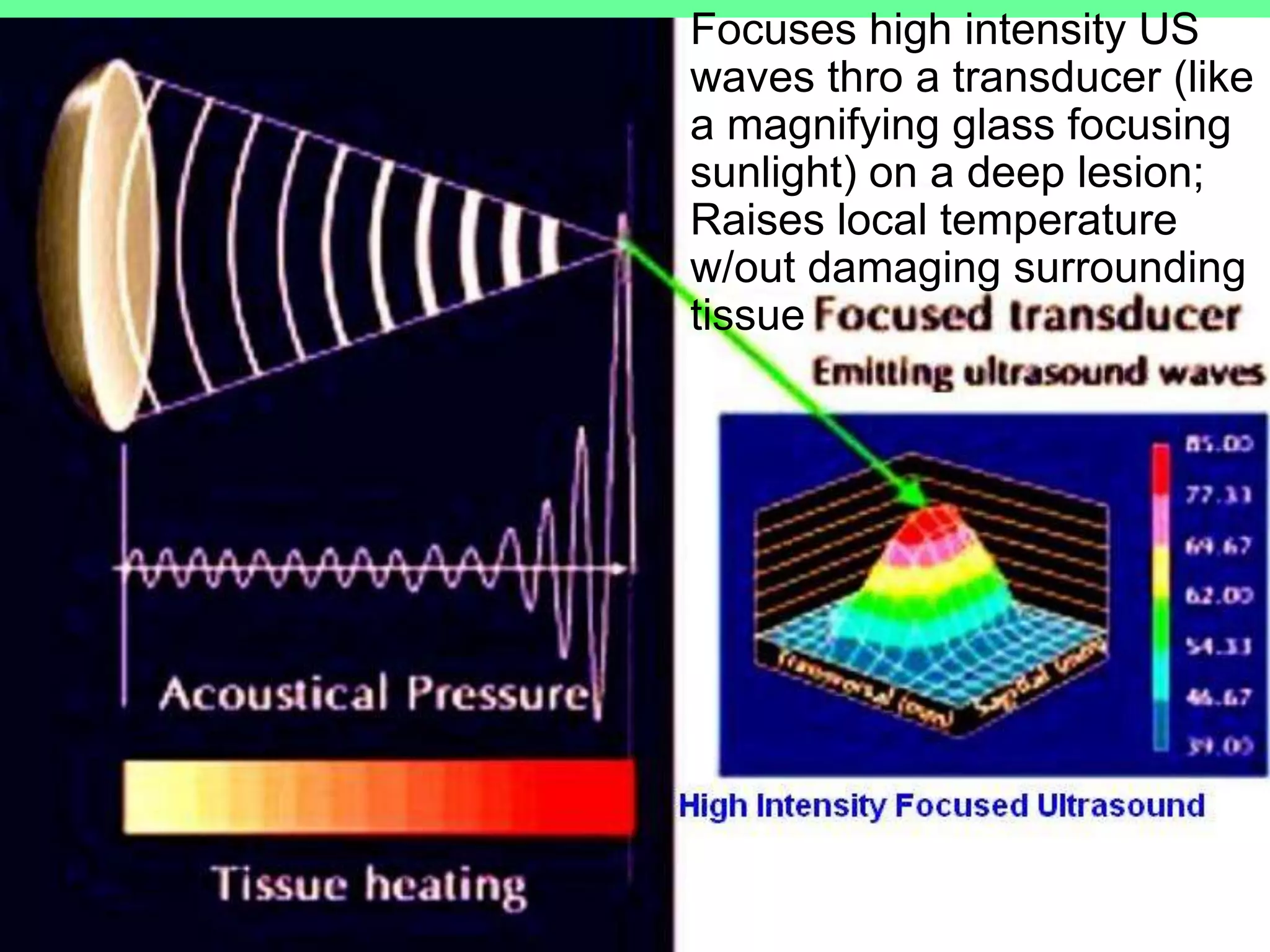 Focuses high intensity US
waves thro a transducer (like
a magnifying glass focusing
sunlight) on a deep lesion;
Raises local temperature
w/out damaging surrounding
tissue
 