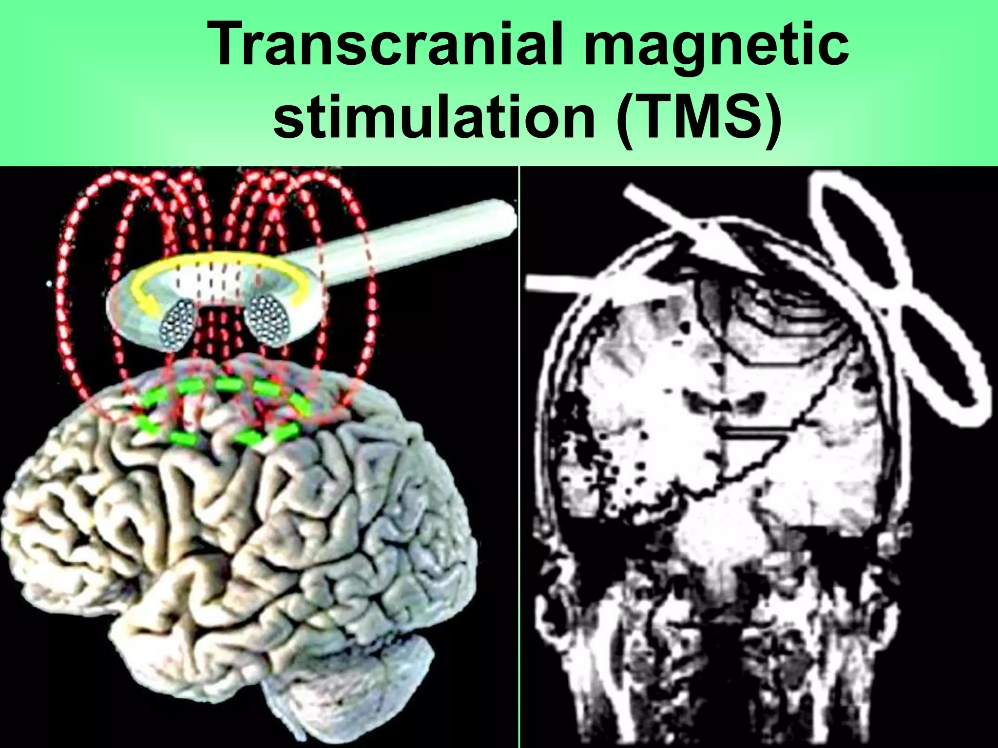 Transcranial magnetic
stimulation (TMS)
 