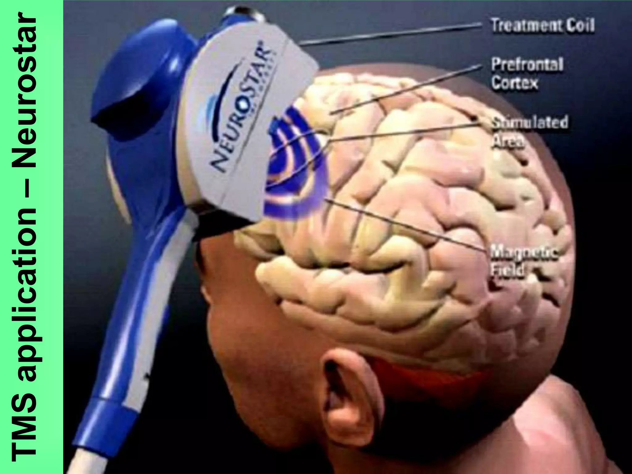TMSapplication–Neurostar
 