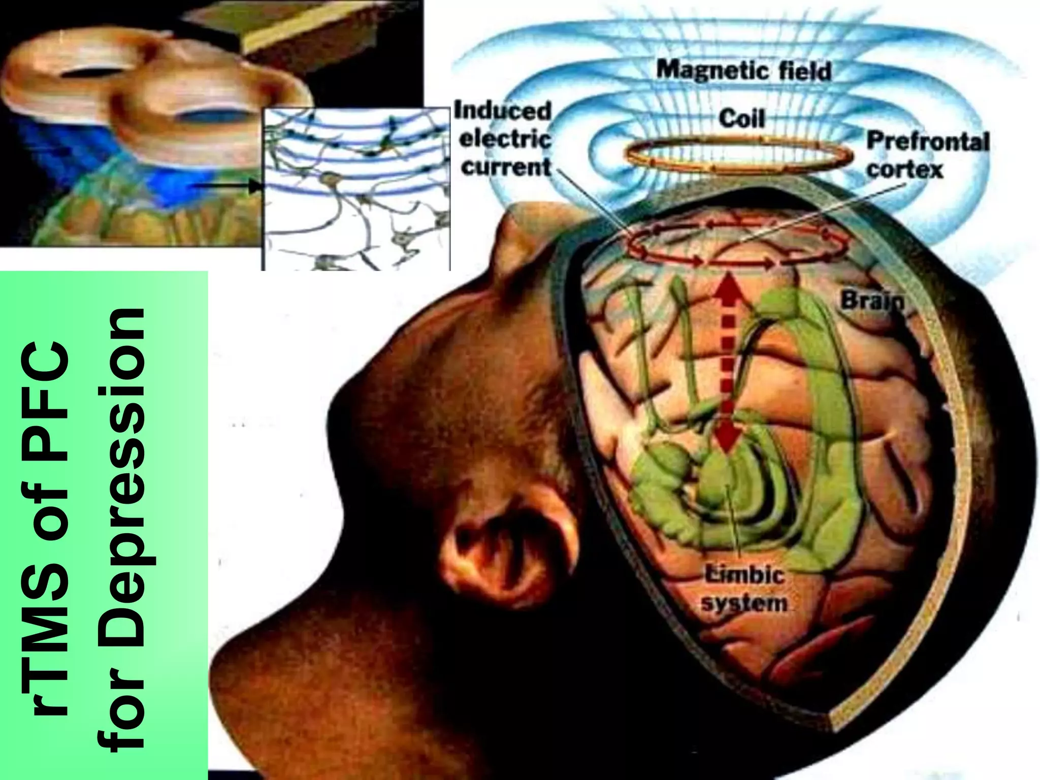 rTMSofPFC
forDepression
 