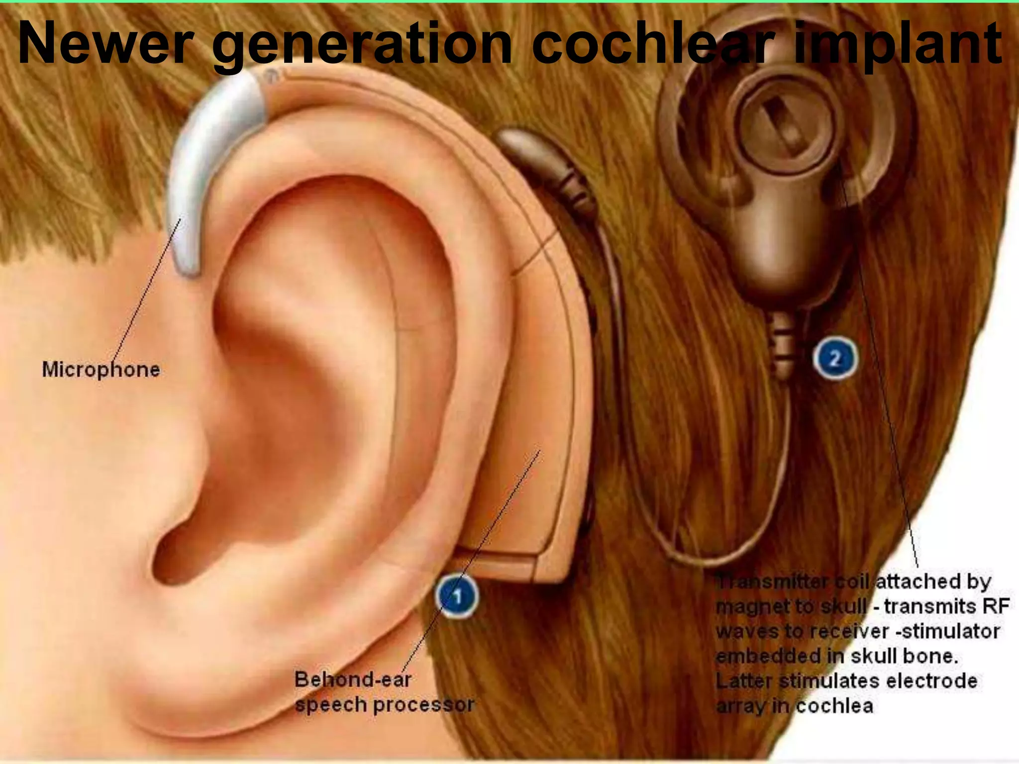 Newer generation cochlear implant
 