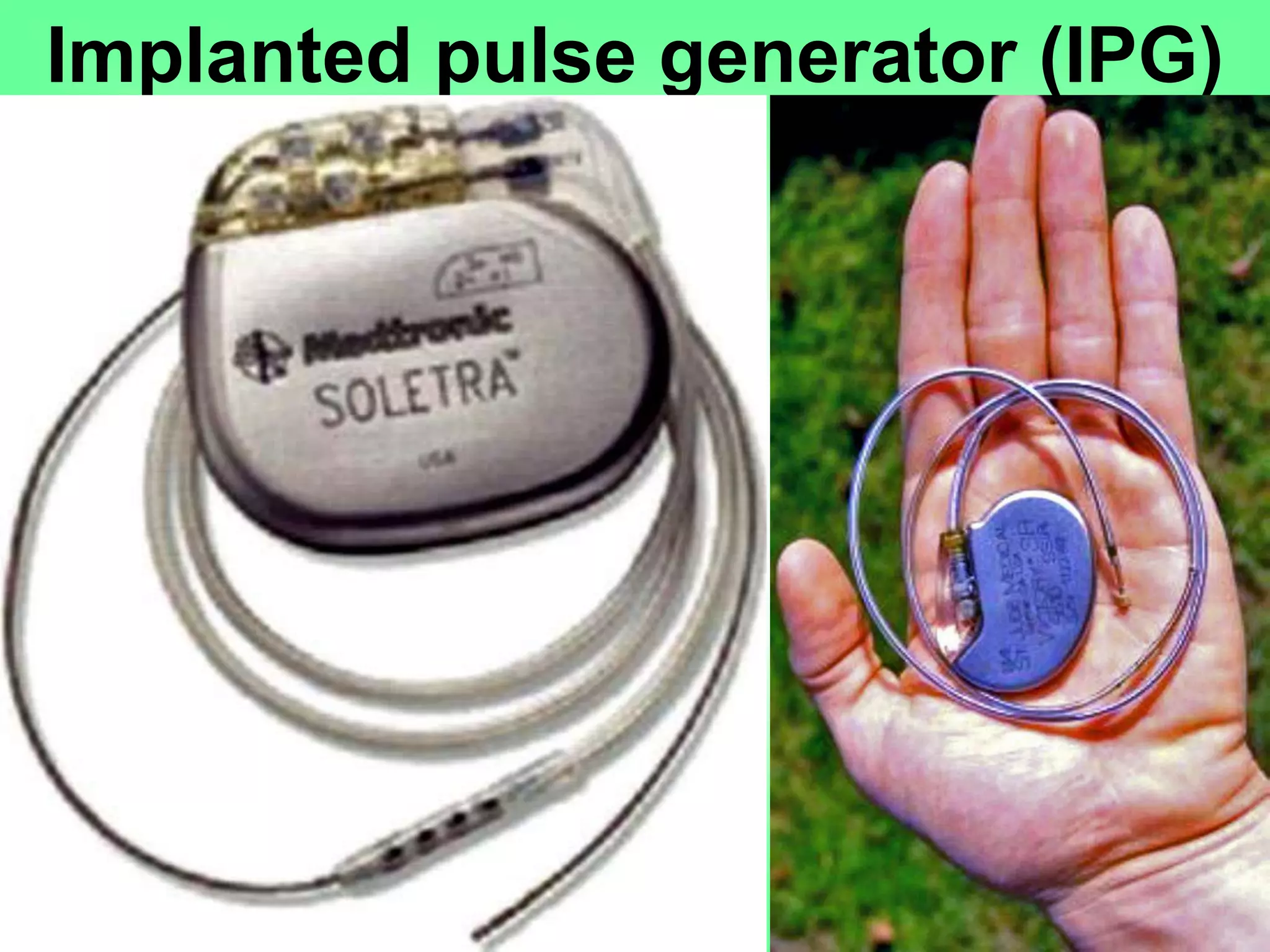 Implanted pulse generator (IPG)
 