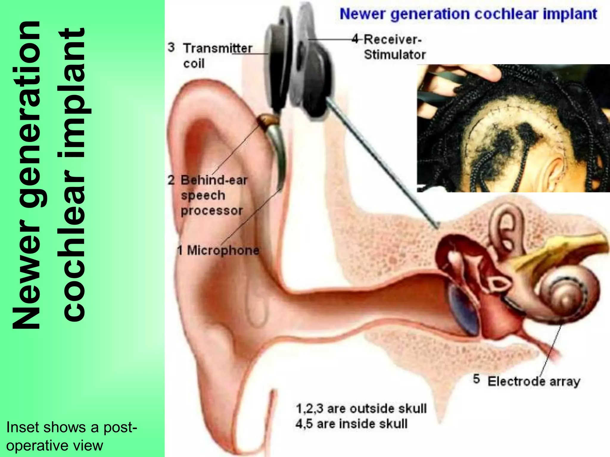 Newergeneration
cochlearimplant
Inset shows a post-
operative view
 