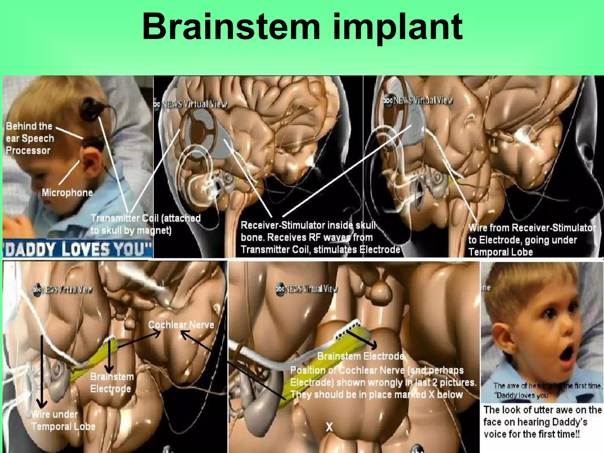 Brainstem implant
 