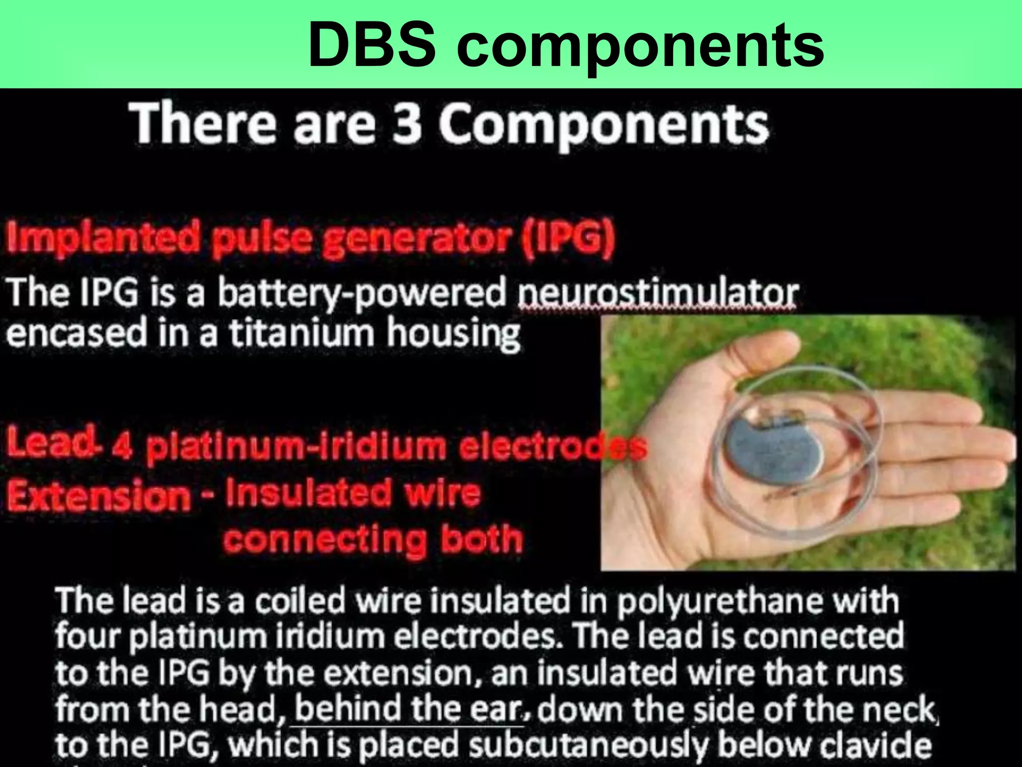 DBS components
 