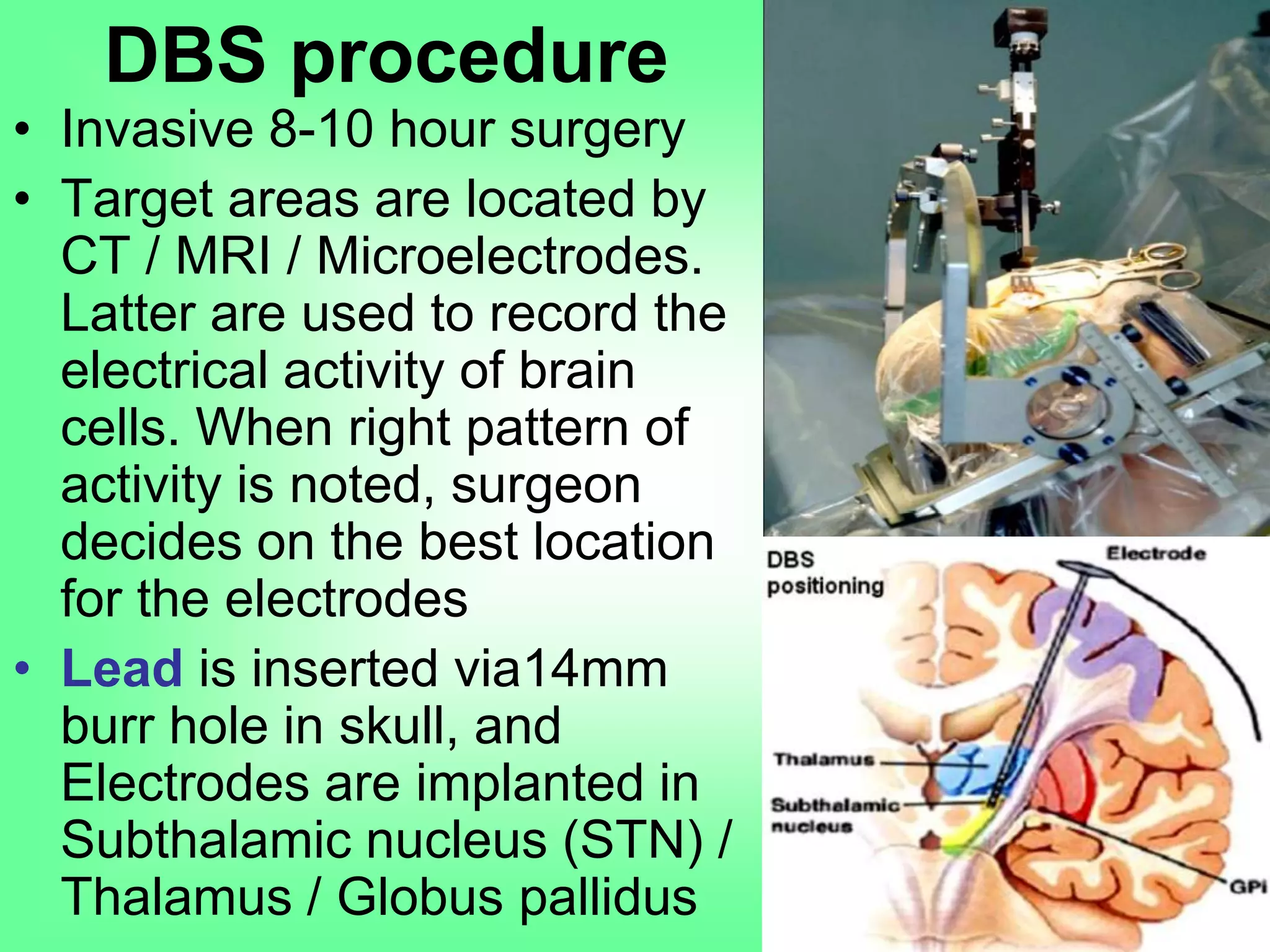 • Invasive 8-10 hour surgery
• Target areas are located by
CT / MRI / Microelectrodes.
Latter are used to record the
electrical activity of brain
cells. When right pattern of
activity is noted, surgeon
decides on the best location
for the electrodes
• Lead is inserted via14mm
burr hole in skull, and
Electrodes are implanted in
Subthalamic nucleus (STN) /
Thalamus / Globus pallidus
DBS procedure
 