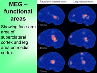 MEG –
functional
areas
Showing face-arm
area of
superolateral
cortex and leg
area on medial
cortex
 