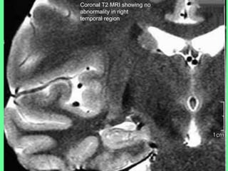 Coronal T2 MRI showing no
abnormality in right
temporal region
 
