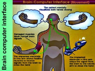Braincomputerinterface
 