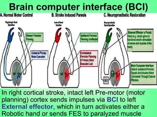 Brain computer interface (BCI)
In right cortical stroke, intact left Pre-motor (motor
planning) cortex sends impulses via BCI to left
External effector, which in turn activates either a
Robotic hand or sends FES to paralyzed muscle
 