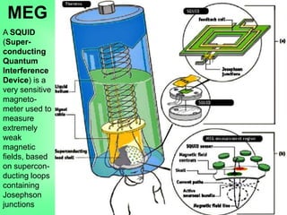 MEG
A SQUID
(Super-
conducting
Quantum
Interference
Device) is a
very sensitive
magneto-
meter used to
measure
extremely
weak
magnetic
fields, based
on supercon-
ducting loops
containing
Josephson
junctions
 