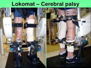 Lokomat – Cerebral palsy
 