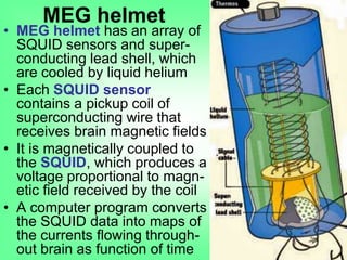 • MEG helmet has an array of
SQUID sensors and super-
conducting lead shell, which
are cooled by liquid helium
• Each SQUID sensor
contains a pickup coil of
superconducting wire that
receives brain magnetic fields
• It is magnetically coupled to
the SQUID, which produces a
voltage proportional to magn-
etic field received by the coil
• A computer program converts
the SQUID data into maps of
the currents flowing through-
out brain as function of time
MEG helmet
 