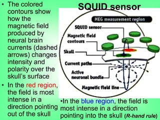 • The colored
contours show
how the
magnetic field
produced by
neural brain
currents (dashed
arrows) changes
intensity and
polarity over the
skull‟s surface
• In the red region,
the field is most
intense in a
direction pointing
out of the skull
•In the blue region, the field is
most intense in a direction
pointing into the skull (R-hand rule)
SQUID sensor
 