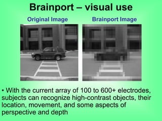 Original Image Brainport Image
Brainport – visual use
• With the current array of 100 to 600+ electrodes,
subjects can recognize high-contrast objects, their
location, movement, and some aspects of
perspective and depth
 