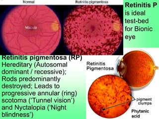 Retinitis pigmentosa (RP)
Hereditary (Autosomal
dominant / recessive);
Rods predominantly
destroyed; Leads to
progressive annular (ring)
scotoma („Tunnel vision‟)
and Nyctalopia („Night
blindness‟)
Retinitis P
is ideal
test-bed
for Bionic
eye
 
