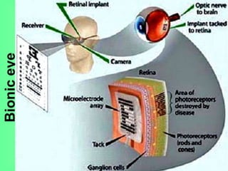 Bioniceye
 