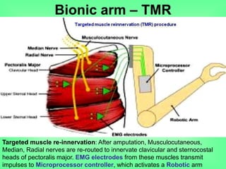 Bionic arm – TMR
Targeted muscle re-innervation: After amputation, Musculocutaneous,
Median, Radial nerves are re-routed to innervate clavicular and sternocostal
heads of pectoralis major. EMG electrodes from these muscles transmit
impulses to Microprocessor controller, which activates a Robotic arm
 