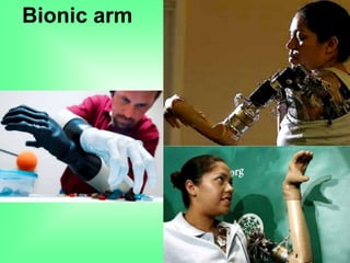 Bionic arm
 