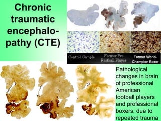 Chronic
traumatic
encephalo-
pathy (CTE)
Pathological
changes in brain
of professional
American
football players
and professional
boxers, due to
repeated trauma
 
