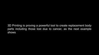 3D Printing is proving a powerful tool to create replacement body
parts including those lost due to cancer, as the next example
shows
 