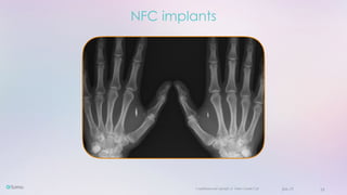 Confidential and copyright of Somo Custom Ltd. June 23 18
NFC implants
 