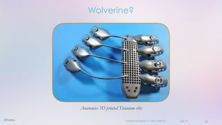 Confidential and copyright of Somo Custom Ltd. June 23 28
Wolverine?
Anatomics 3D printed Titanium ribs
 