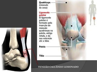 TENDÃO CALCÂNEO LESIONADO
 