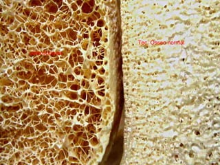 Tec. Ósseo normal
osteosporose
 