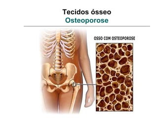 Tecidos ósseo
 Osteoporose
 